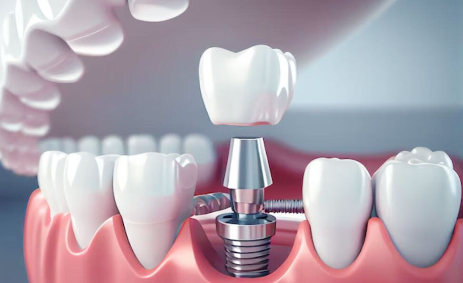 Quid sunt components dentalis implantatorum?