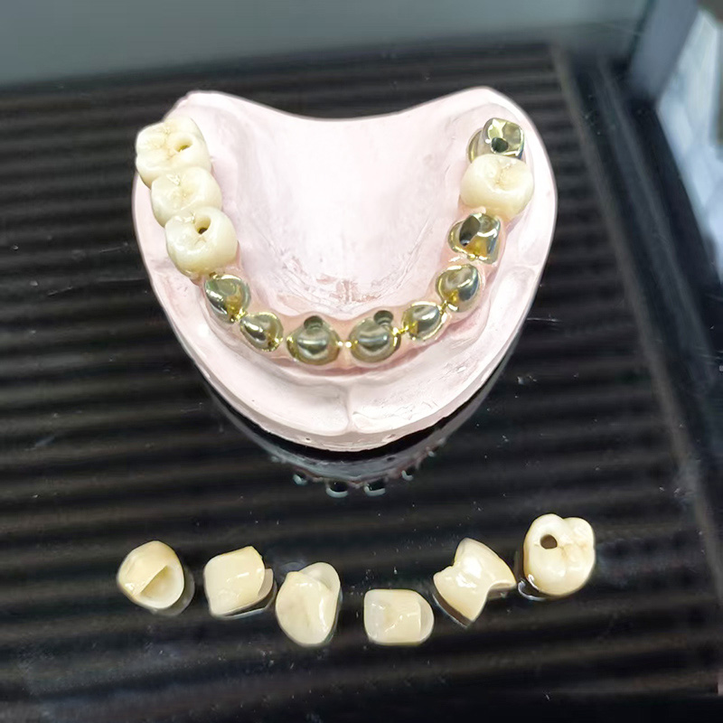 Full Arch Metal‑ Ceramic Pons (PFM Plena Arcus Prosthesis)
